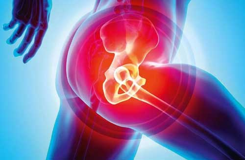 Hip Replacement Surgery