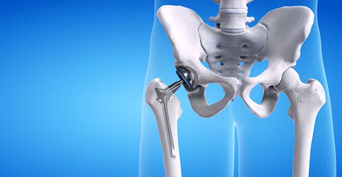 The Road to Recovery: Tips After Hip Replacement Surgery