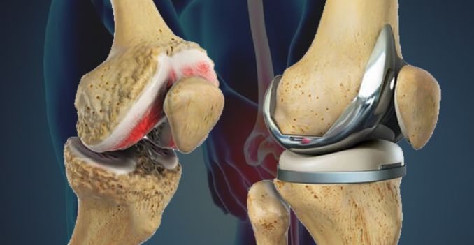 How Knee Replacement Boosts Mobility & Quality of Life