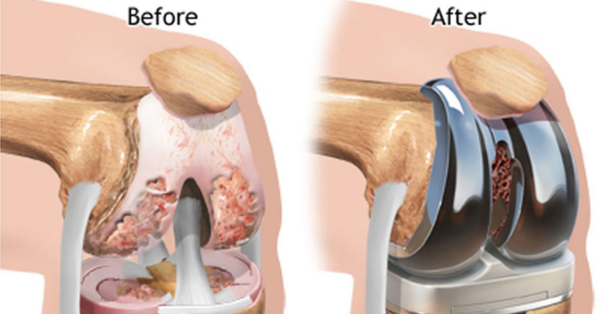 What to Expect Before, During & After Knee Replacement