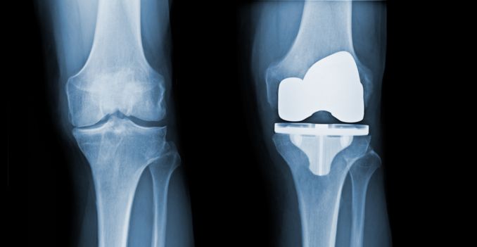 Tips for a Smooth Knee Replacement Recovery Journey