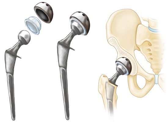 Latest Hip Replacement Treatment Options in Delhi - Dr. Palash Gupta